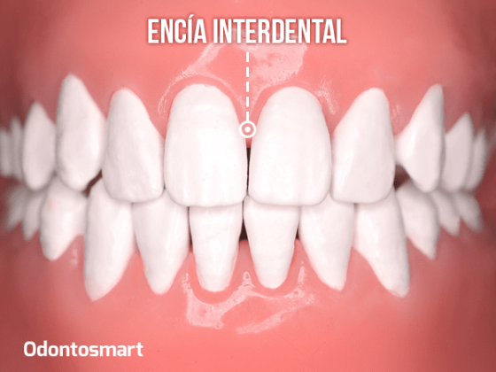 Encía interdental Encía interdental