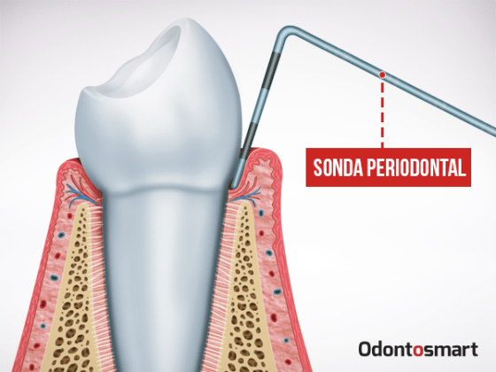 En la periodoncia se utiliza el sondaje periodontal En la periodoncia se utiliza el sondaje periodontal